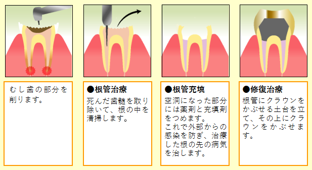 根幹治療の手順