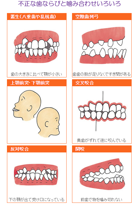 不正な歯並びと噛み合わせいろいろ