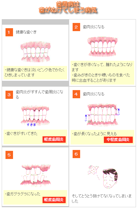 歯周病は歯が抜けてしまう病気