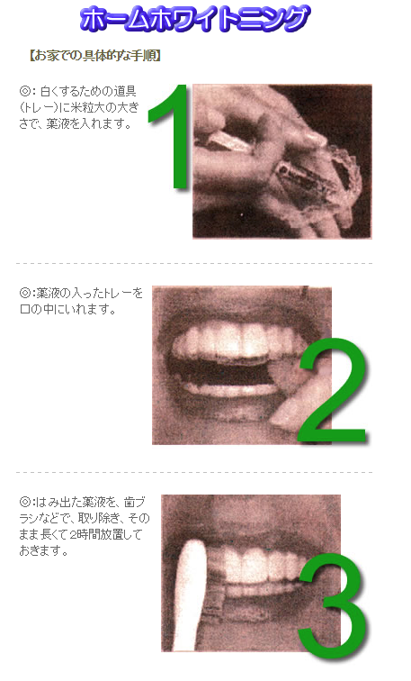 ホワイトニングの手順