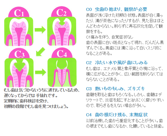 むし歯の進行具合