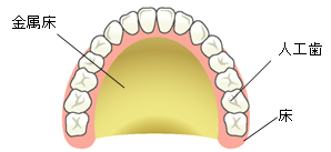 総入れ歯のイメージ