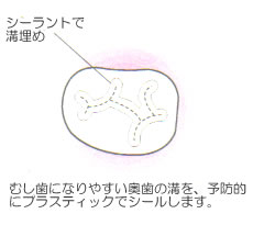 溝埋め（シーラント）のイメージ