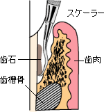 ルートプレーニング