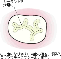 シーラント