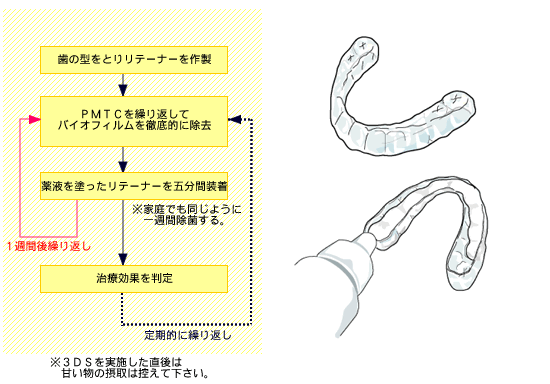 歯の型をとりリテーナーを作製　ＰＭＴＣを繰り返してバイオフィルムを徹底的に除去　薬液を塗ったリテーナーを五分間装着　１週間後繰り返し※家庭でも同じように一週間除菌する。　治療効果を判定　定期的に繰り返し　※３ＤＳを実施した直後は甘い物の摂取は控えて下さい。