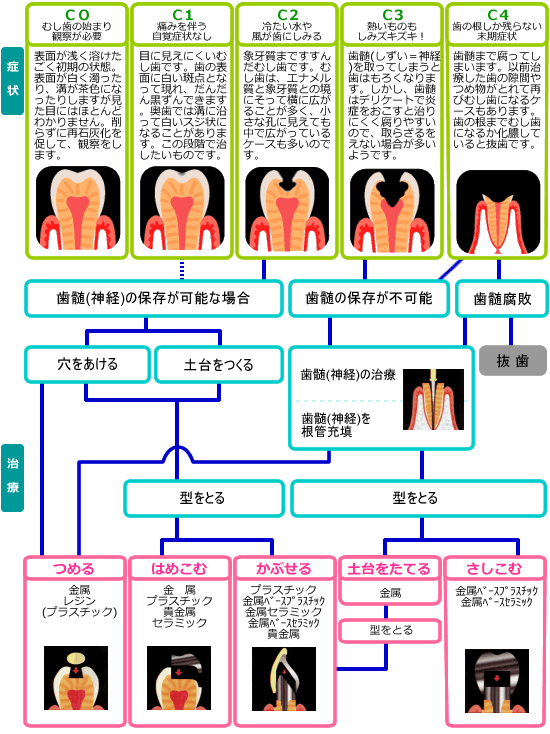 症状：ＣＯ　むし歯の始まり観察が必要　　表面が浅く溶けた、ごく初期の状態。表面が白く濁ったり、溝が茶色になったりしますが、見た目にはほとんどわかりません。削らずに再石灰化を促して、観察をします。　　Ｃ１　痛みを伴う自覚症状なし　　目に見えにくいむし歯です。歯の表面に白い斑点となって現れ、だんだん黒ずんできます。奥歯では溝に沿って白いスジ状になることがあります。この段階で治したいものです。　　Ｃ２　冷たい水や風が歯にしみる　　象牙質まですすんだむし歯です。むし歯は、エナメル質と象牙質との境にそって横に広がることが多く、小さな孔に見えても中で広がっているケースも多いのです。　　Ｃ３　熱いものもしみズキズキ　　歯髄(しずい＝神経)を取ってしまうと歯はもろくなります。しかし、歯髄はデリケートで炎症をおこすと治りにくく腐りやすいので、取らざるをえない場合が多いようです。　　Ｃ４　歯の根しか残らない末期症状　　歯髄まで腐ってしまいます。以前治療した歯の隙間やつめ物がとれて再びむし歯になるケースもあります。歯の根までむし歯になるか化膿していると抜歯です。　　治療：歯髄(神経)の保存が可能な場合　穴をあける　土台をつくる　型をとる　歯髄の保存が不可能　歯髄(神経)の治療　歯髄(神経)を根管充填　歯髄腐敗　抜歯　　型をとる　金属　レジン(プラスチック)　　はめこむ　金属　プラスチック　貴金属　セラミック　　かぶせる　プラスチック　金属ベースプラスチック　金属セラミック　金属ベースセラミック　貴金属　　土台をたてる　金属　型を取る　　さしこむ　金属ベースプラスチック　金属ベースセラミック