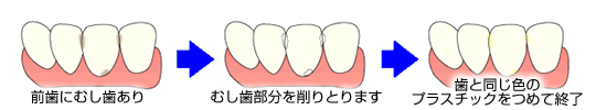 前歯にむし歯あり→むし歯部分を削りとります→歯と同じ色のプラスチックをつめて終了