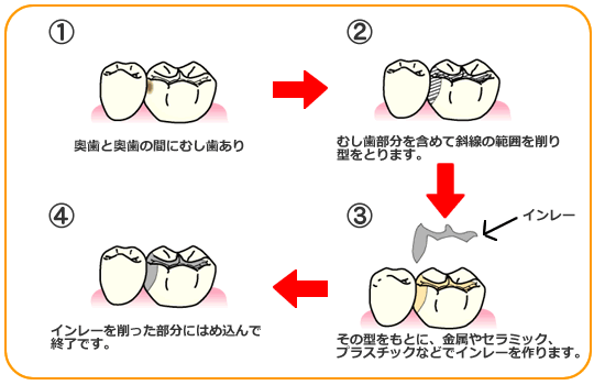 奥歯と奥歯の間にむし歯あり　　2、むし歯部分を含めて斜線の範囲を削り型をとります。　　3、その型をもとに、金属やセラミック、プラスチックなどでインレーを作ります。　　4、インレーを削った部分にはめ込んで終了です。