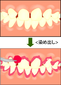 プラークの染め出し