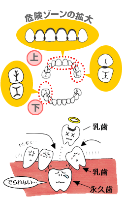 危険ゾーンの拡大　上　下　乳歯　乳歯　永久歯　でられない…