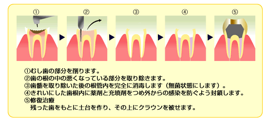 １，むし歯の部分を削ります。　２，歯の根の中の悪くなっている部分を取り除きます。　３，歯髄を取り除いた後の根管内を完全に消毒します（無菌状態にします）。　４，きれいにした歯根内に薬剤と充填剤をつめ外からの感染を防ぐよう封鎖します。　５，修復治療
残った歯をもとに土台を作り、その上にクラウンを被せます。
