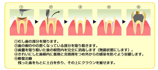 歯ブラシの寿命は？