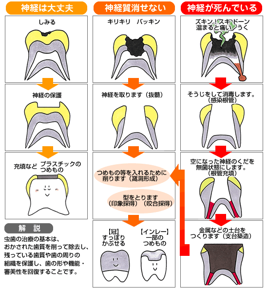 神経は大丈夫　しみる　神経の保護　充填などプラスチックのつめもの　　　神経質消せない　キリキリ　バッキン　神経を取ります（抜髄）　つめもの等を入れるために削ります（窩洞形成）　型をとります（印象採得）（咬合採得）　【冠】すっぽりかぶせる　【インレー】一部のつめもの　　　神経が死んでいる　ズキン！ズキドーン　温まると痛い　うく　そうじをして消毒します。（感染根管）　空になった神経のくだを無菌状態に密閉します。(根管充填）　金属などの土台をつくります（支台築造）　　　解説　むし歯の治療の基本は、おかされた歯質を削って除去し、残っている歯質や歯の周りの組織を保護し、歯の形や機能・審美性を回復することです。