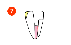 歯の根っこ7
