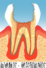 歯根膜炎のイメージ