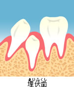 埋伏歯のイメージ
