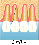 歯牙破裂のイメージ