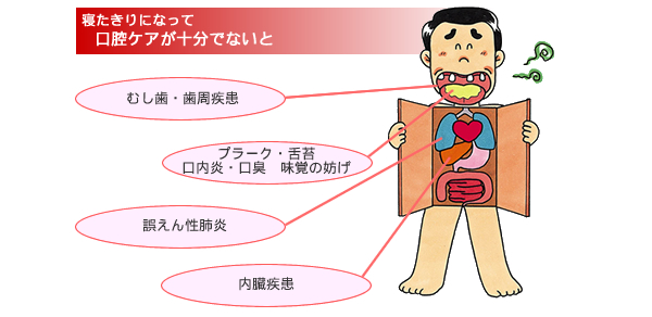 寝たきりになって口腔ケアが十分でないと　むし歯・歯周疾患　プラーク・舌苔　口内炎・口臭　味覚の妨げ　誤えん性肺炎　内臓疾患