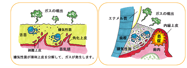 唾液の分泌が減少するため　腐敗したむし歯扁桃からの排膿、糖尿病　潔癖症の人に多い