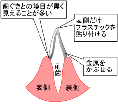 保険で作ったクラウンのイメージ