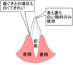 オールセラミッククラウンのイメージ