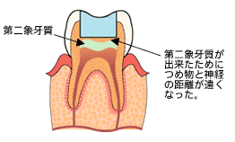 第二象牙質