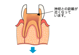 修復中の歯