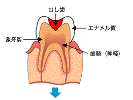 むし歯