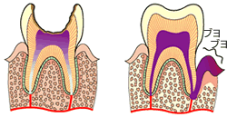 歯髄炎のイメージ