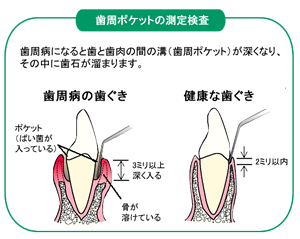 歯周ポケットの測定検査