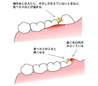 下顎智歯周囲炎のイメージ