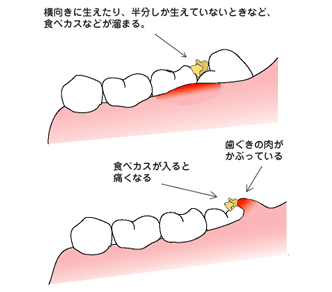 周囲 炎 智歯