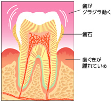 歯周病