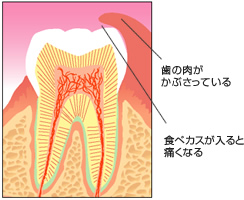 歯の肉がぶさっている