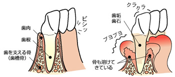 歯の土台のイメージ