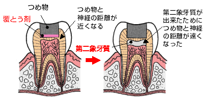 つめ物と神経の距離が近くなる→第二象牙質が出来たためにつめ物と神経の距離が遠くなった