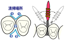 歯間ブラシの使い方