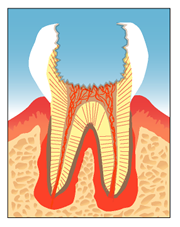 画像：通常の歯内治療と残根の歯内治療