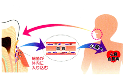 画像：残根の歯内治療・残根だけなのでこのままでは抜かなければなりません。歯の根にひっかかりを作ってゴムを利用して下に引き出します。徐々に歯の根が引っ張り出されました。