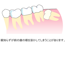 画像：分割抜歯のイメージ