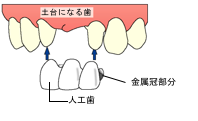 人工歯のイメージ