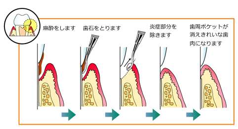 歯周ポケット掻爬のイメージ