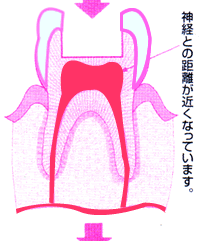 第二象牙質