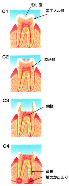 虫歯の進行状況のイメージ