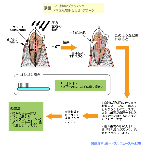 ＷＳＤくさび状欠損のイメージ