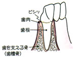 画像：歯周病の進行　初期