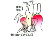 画像：歯周病中等度