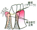 画像：歯肉炎