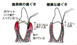 画像：歯周病ポケット